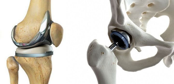 Joint Replacement